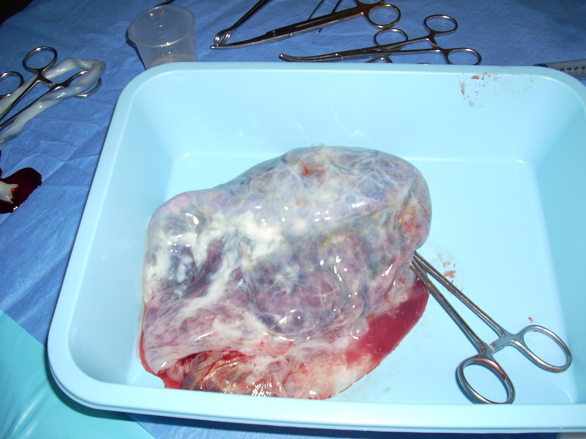 Quels sont les meilleurs soins pour le cordon ombilical ?